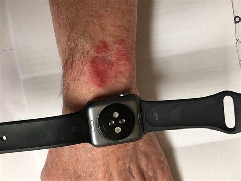 apple watch hautirritationen|apple watch rash treatment.